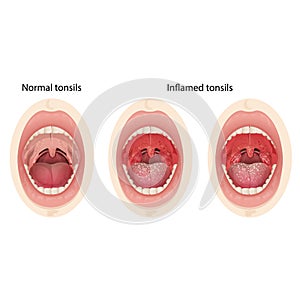 Normal and inflamed tonsils. Illustration of a throat bacterial and viral infection.