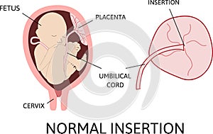 Normal insertion of umbilical cord.  Medical vector illustration