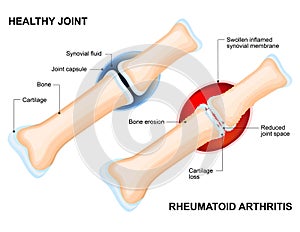 Normal Joint and Rheumatoid Arthritis