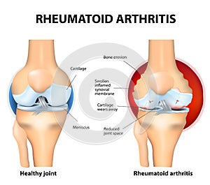 Normal Joint and Rheumatoid Arthritis