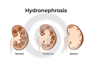 Normal kidney with hydronephrosis. Vector illustration of the of the kidney anatomy with dilated kidneys