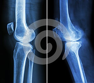 Normal knee left image and osteoarthritis knee right image lateral view