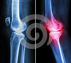 Normal knee and osteoarthritis knee