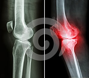 Normal knee and osteoarthritis knee