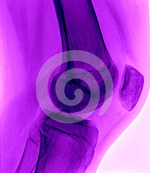 Normal Knee xray - purple