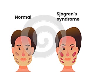 Normal lacrimal and salivary gland versus sjogren`s syndrome photo
