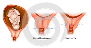 Normal length and short cervix photo