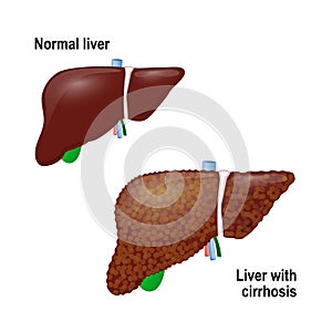 Normal liver and liver with Cirrhosis photo