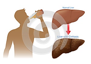 Normal liver of human change to the cirrhosis because drinking alcohol. photo