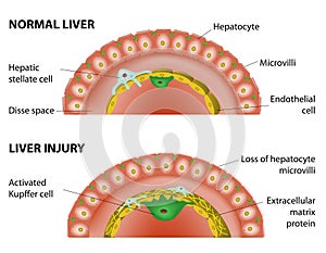 Normal liver and liver injury.