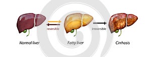 Normal liver versus liver with Cirrhosis, damaged liver, excessive drinking of alcohol, treatment