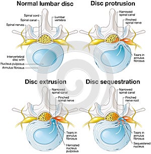 Normal lumbar disc. Disc protrusion. Disc extrusion. Disc sequestion. Labeled illustration photo