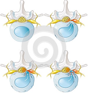 Normal lumbar disc. Disc protrusion. Disc extrusion. Disc sequestion. Labeled illustration photo