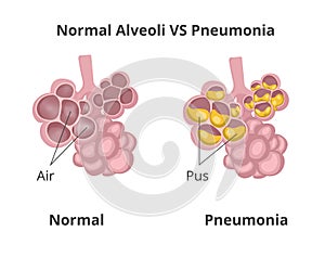 Normal lung alveoli versus pneumonia