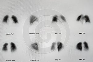 Lung ventilation - perfusion Imaging - Normal VQ scan photo