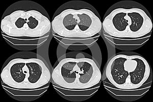 Normal lungs on computed tomography photo
