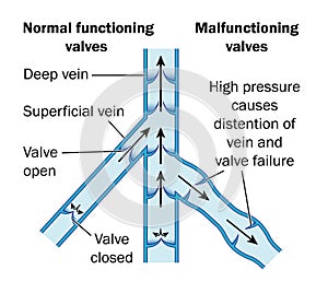 Normal and malfunctioning vein valves