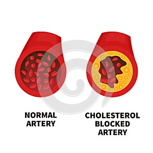 Normal and narrowed artery cross section illustration