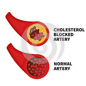 Normal and narrowed artery cross section illustration