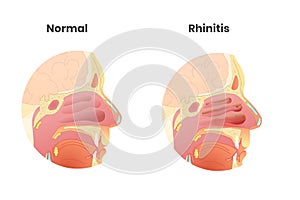 Normal nasal cavity versus rhinitis anatomy illustration