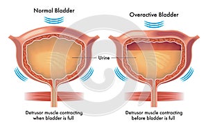 Normal and overactive bladder