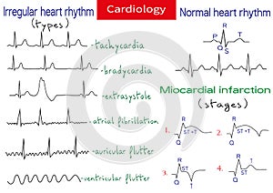 Normal and pathological ecg collection.