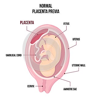 Normal Placental previa. Usual anatomical Placenta Location During Pregnancy. photo
