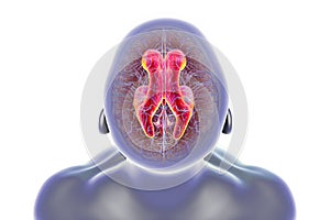 Normal pressure hydrocephalus, 3D illustration