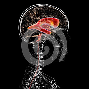 Normal pressure hydrocephalus, 3D illustration