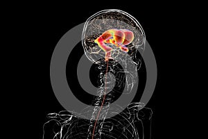 Normal pressure hydrocephalus, 3D illustration