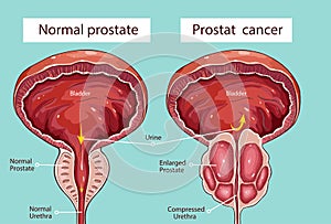 Normal prostate and acute prostatitis. Medical illustration photo