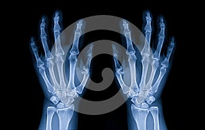 Normal x-ray of both hands. Osteoarthritis of hand and joint. X-ray both hands in hospital.