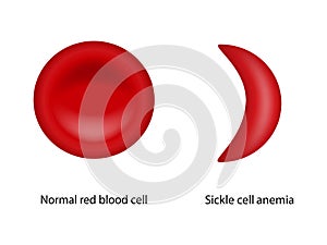 Normálně krev buňka a srp buňka anémie 