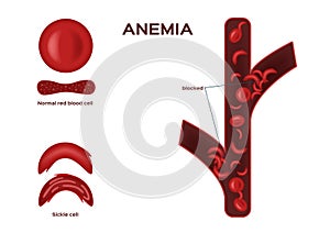 Normal red blood cell and sickle cell vector / anemia