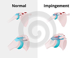 Normal shoulder and impingement. Illustration of the normal shoulder anatomy and impingement disorder photo