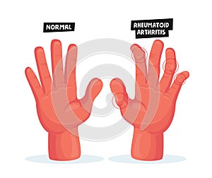 Normal and Sick Hands with Rheumatoid Arthritis, Osteoarthritis. Finger Joints Inflammation Medical Healthcare Concept.