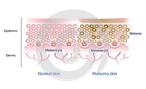 Normal skin layer and melasma skin layer vector. photo