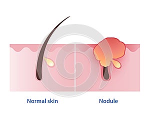 Normal skin and Nodule, type of inflammatory acne vector on white background. photo