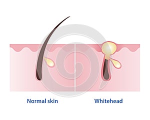 Normal skin and whitehead acne vector illustration isolated on white background.