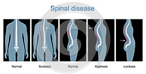 Normal spine and Spinal deformity from Scoliosis to Lordosis and Kyphosis