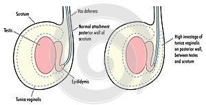 Normal testicle and testicle with high tunica vaginalis photo