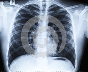 Normal thoracic x-ray image without any findings
