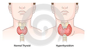 Normal Thyroid and Hyperthyroidism diagram medical