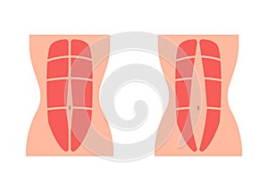 Normal tone muscle abdomen and diastasis recti, weak and divergence abdomen muscle. Rectus abdominal diastasis. Vector