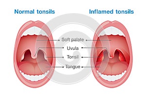 Normal tonsils and inflamed tonsils