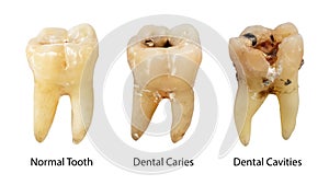 Normal tooth , Dental caries and Dental cavity with calculus . Comparison between difference of teeth decay stages . White