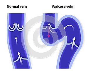 Normal vein and Varicose vein