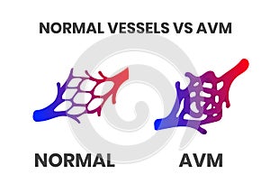 Normal vessels and arteriovenous malformation avm