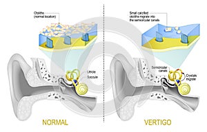 Normal vestibular system and Vertigo when Small calcified otoliths migrate from Saccule and Utricle into the semicircular canals