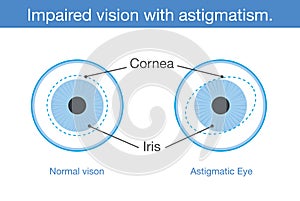 Normal vision and Impaired vision with astigmatism in front view.
